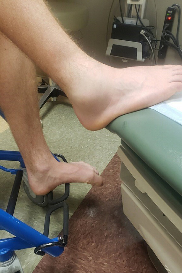 Sprained ankle photo